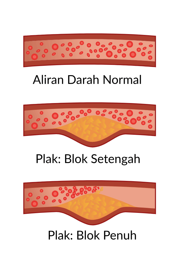 Perbedaan Kondisi Aliran Darah Normal dan Yang Tersumbat Plak pada Pembuluh Darah